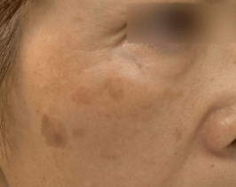 シミ治療のイメージ