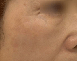 シミ治療のイメージ