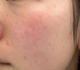 赤ら顔 3回治療後